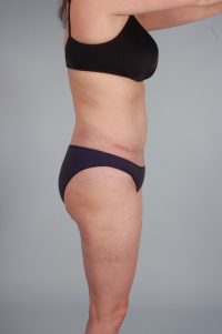 Abdominoplasty (Tummy Tuck)