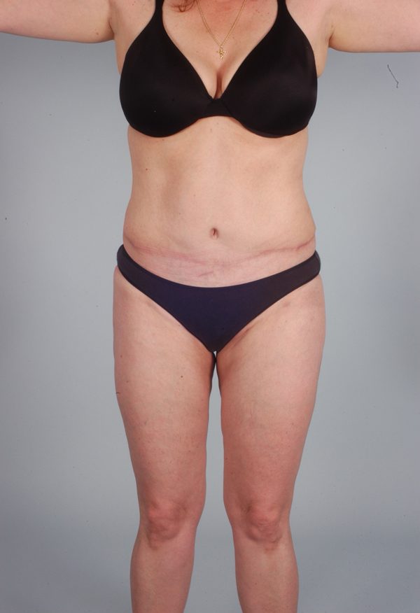 Abdominoplasty (Tummy Tuck)