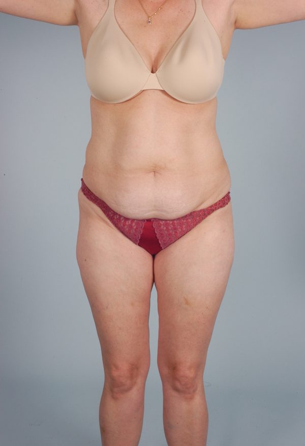 Abdominoplasty (Tummy Tuck)