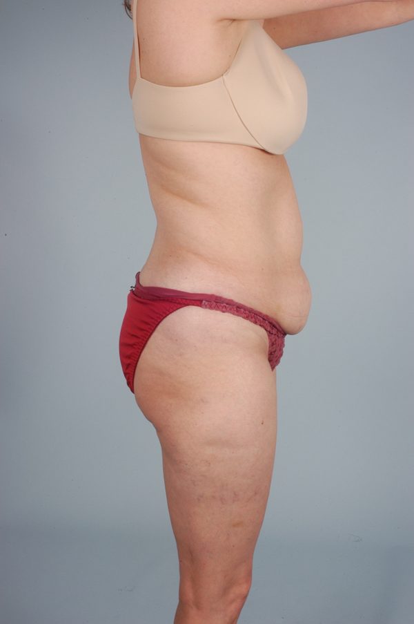 Abdominoplasty (Tummy Tuck)