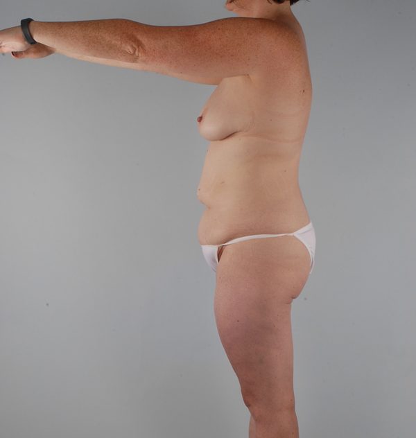 Abdominoplasty (Tummy Tuck) Case 1939 Before Photo Abdominoplasty (Tummy Tuck)