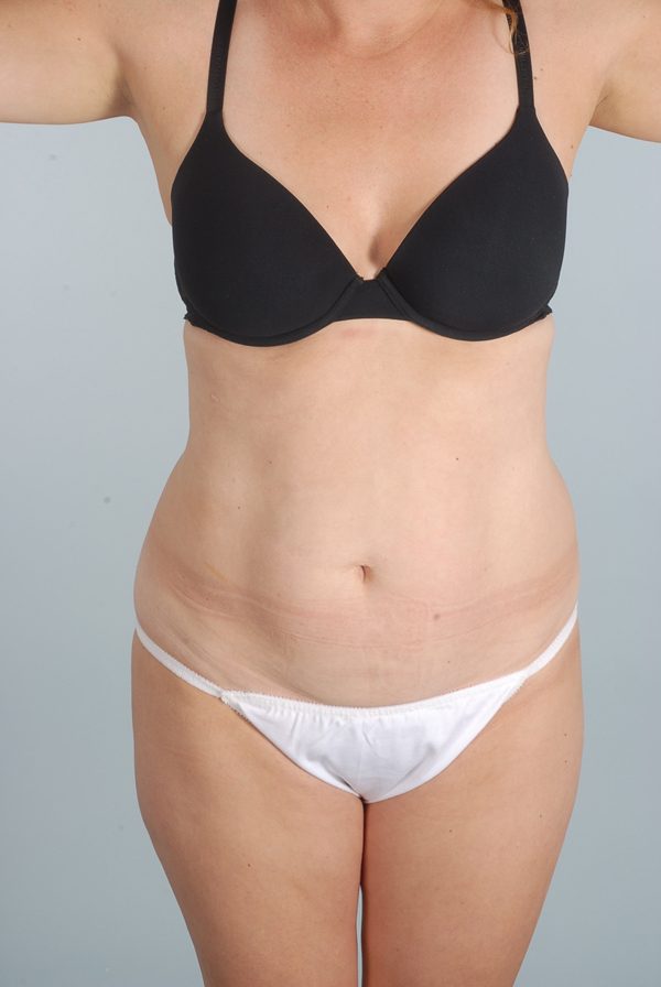 Abdominoplasty (Tummy Tuck) Case 1971 Before Photo Abdominoplasty (Tummy Tuck)
