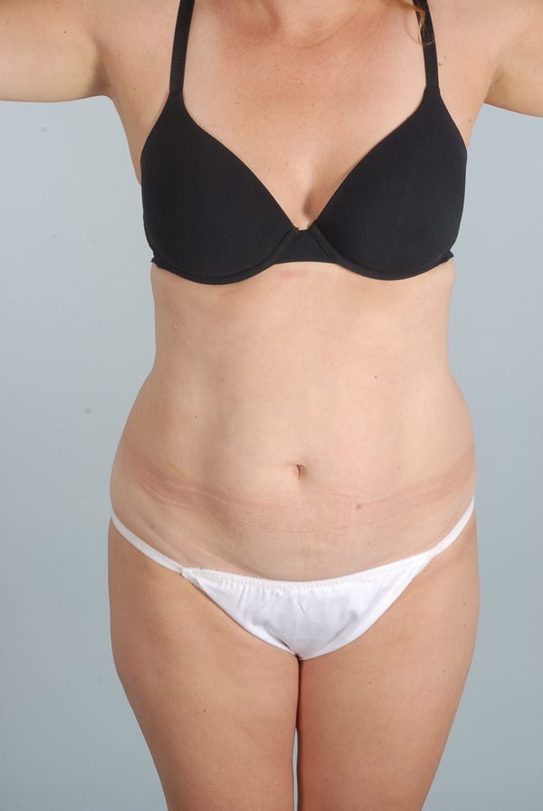 Abdominoplasty (Tummy Tuck)