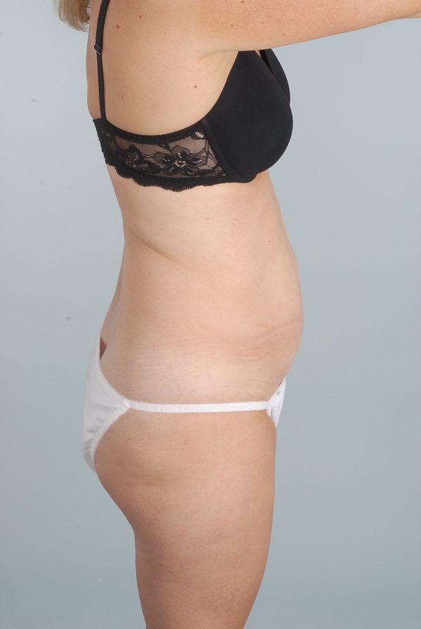 Abdominoplasty (Tummy Tuck) Case 1971 Before Photo Abdominoplasty (Tummy Tuck)