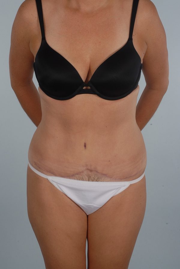Abdominoplasty (Tummy Tuck) Case 1971 After Photo Abdominoplasty (Tummy Tuck)