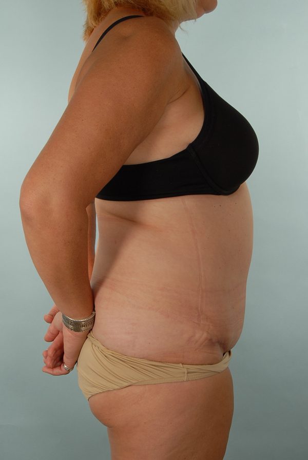 Abdominoplasty (Tummy Tuck) Case 1972 After Photo Abdominoplasty (Tummy Tuck)