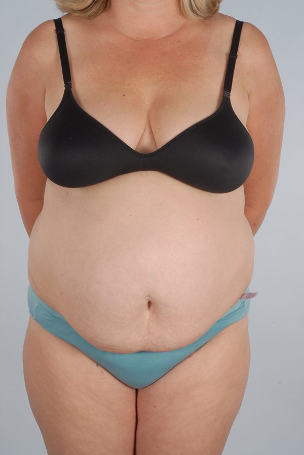 Abdominoplasty (Tummy Tuck) Case 1972 Before Photo Abdominoplasty (Tummy Tuck)