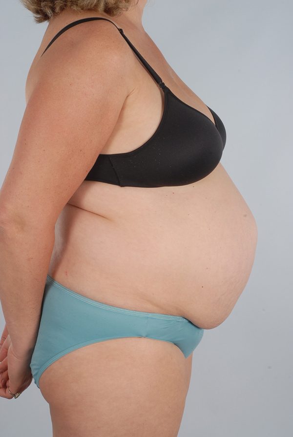 Abdominoplasty (Tummy Tuck) Case 1972 Before Photo Abdominoplasty (Tummy Tuck)
