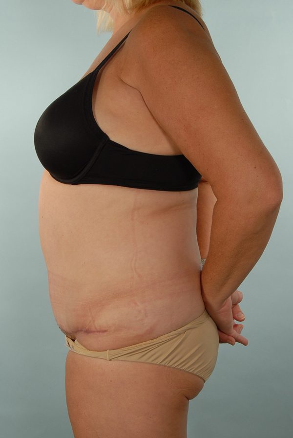 Abdominoplasty (Tummy Tuck) Case 1972 After Photo Abdominoplasty (Tummy Tuck)