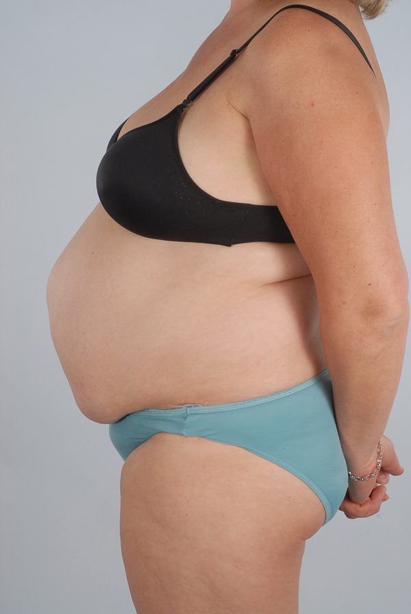 Abdominoplasty (Tummy Tuck) Case 1972 Before Photo Abdominoplasty (Tummy Tuck)