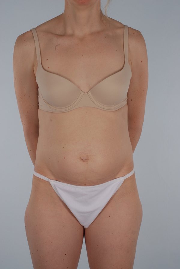 Abdominoplasty (Tummy Tuck) Case 1973 Before Photo Abdominoplasty (Tummy Tuck)