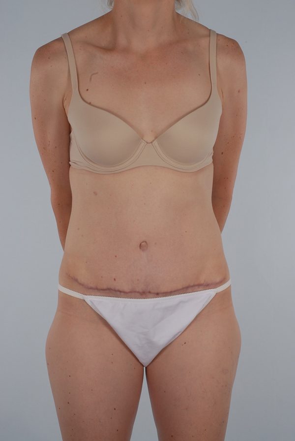 Abdominoplasty (Tummy Tuck) Case 1973 After Photo Abdominoplasty (Tummy Tuck)