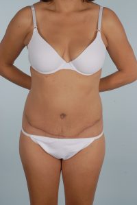 Abdominoplasty (Tummy Tuck)