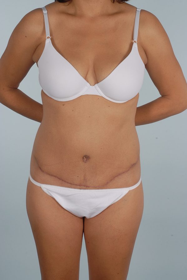 Abdominoplasty (Tummy Tuck) Case 1974 After Photo Abdominoplasty (Tummy Tuck)