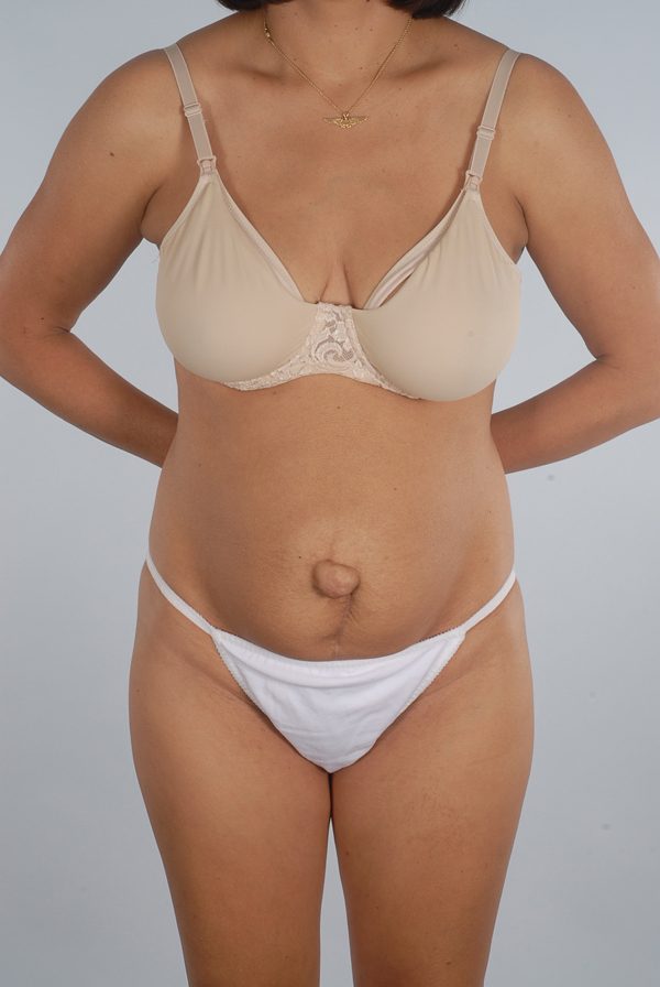 Abdominoplasty (Tummy Tuck) Case 1974 Before Photo Abdominoplasty (Tummy Tuck)