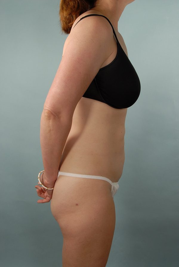 Abdominoplasty (Tummy Tuck)