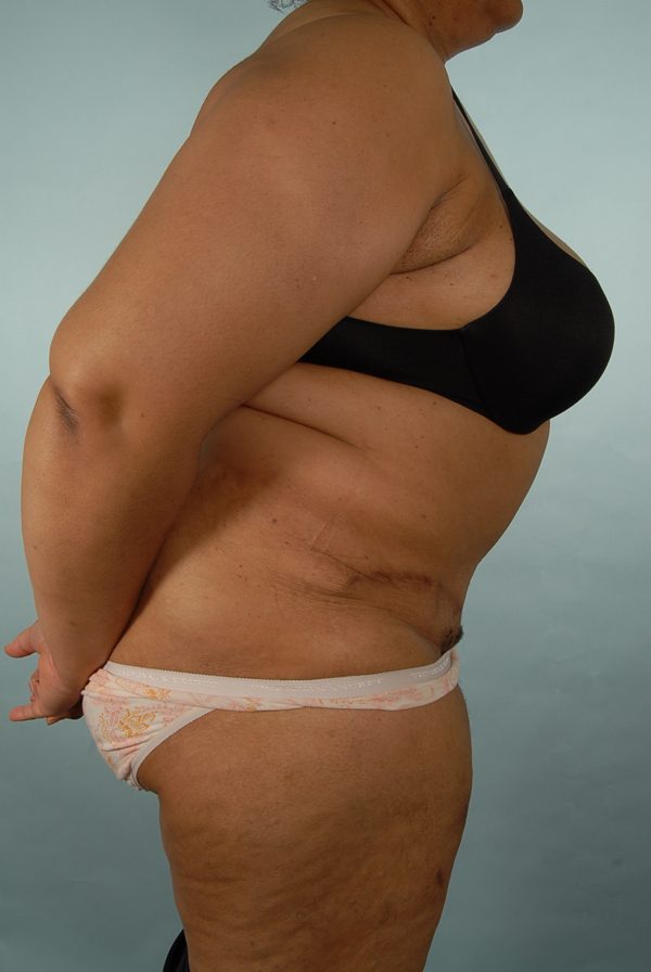 Abdominoplasty (Tummy Tuck)