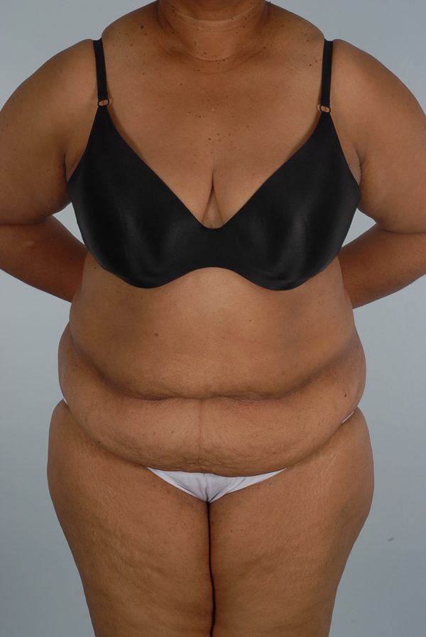 Abdominoplasty (Tummy Tuck)