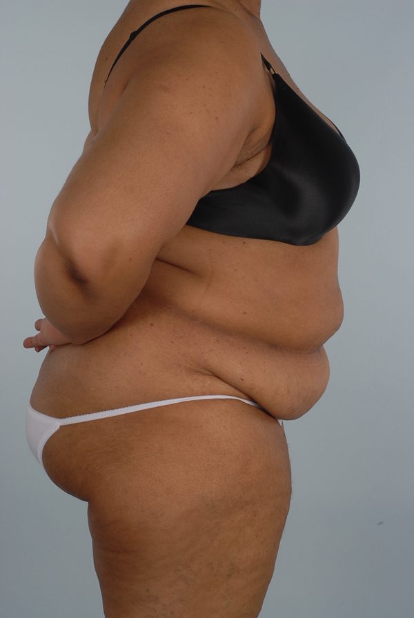 Abdominoplasty (Tummy Tuck)