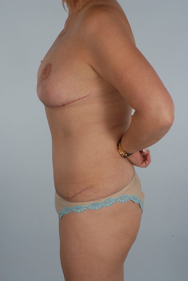 Abdominoplasty (Tummy Tuck) with Breast Reduction/Lift