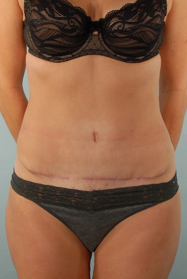 Abdominoplasty (Tummy Tuck)