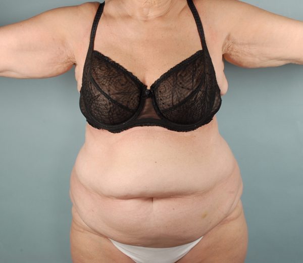 Abdominoplasty (Tummy Tuck) Case 2040 Before Photo Abdominoplasty (Tummy Tuck)