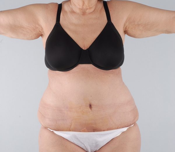 Abdominoplasty (Tummy Tuck) Case 2040 After Photo Abdominoplasty (Tummy Tuck)