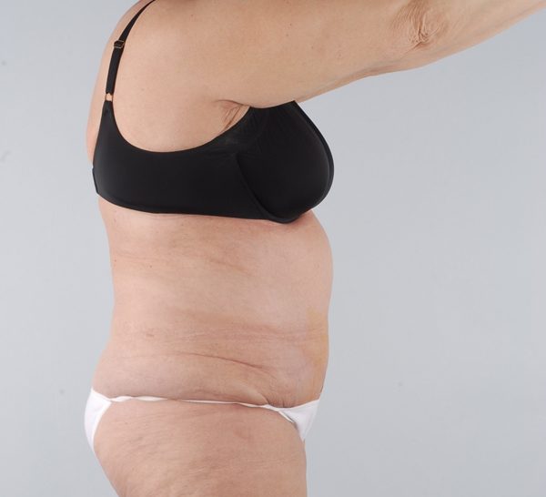 Abdominoplasty (Tummy Tuck)