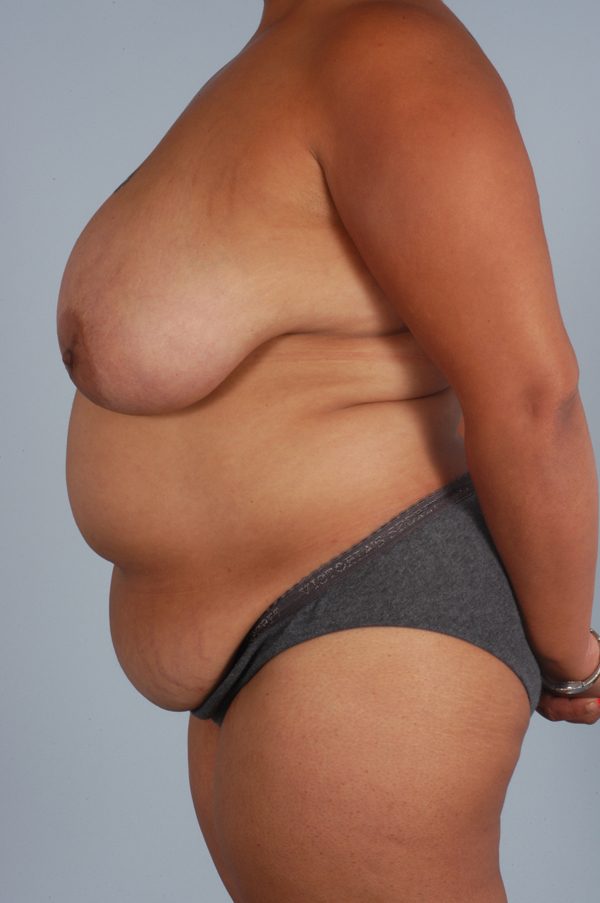 Abdominoplasty (Tummy Tuck) with Breast Reduction/Lift