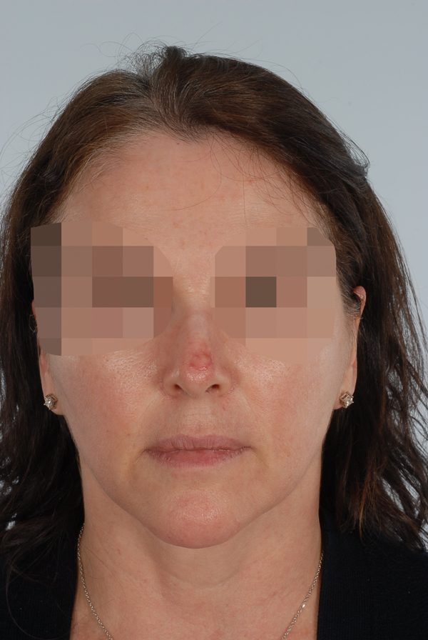 Skin Cancer Case 2082 Before Photo Skin Cancer