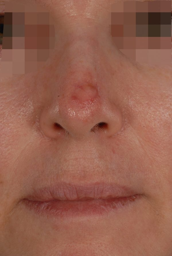 Skin Cancer Case 2082 Before Photo Skin Cancer