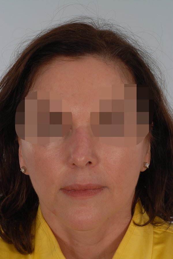 Skin Cancer Case 2082 After Photo Skin Cancer