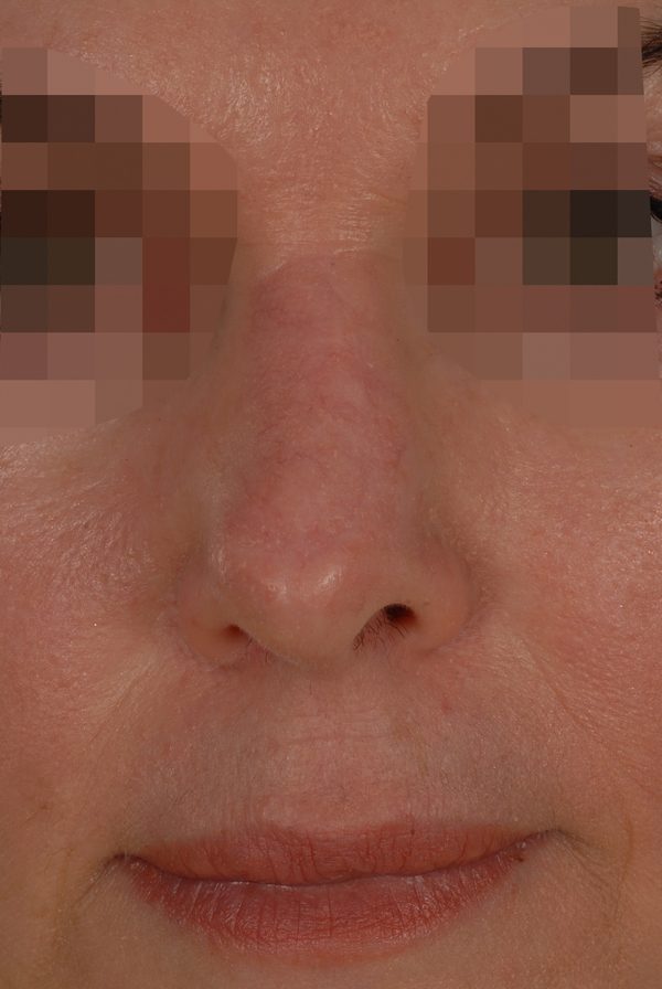 Skin Cancer Case 2082 After Photo Skin Cancer