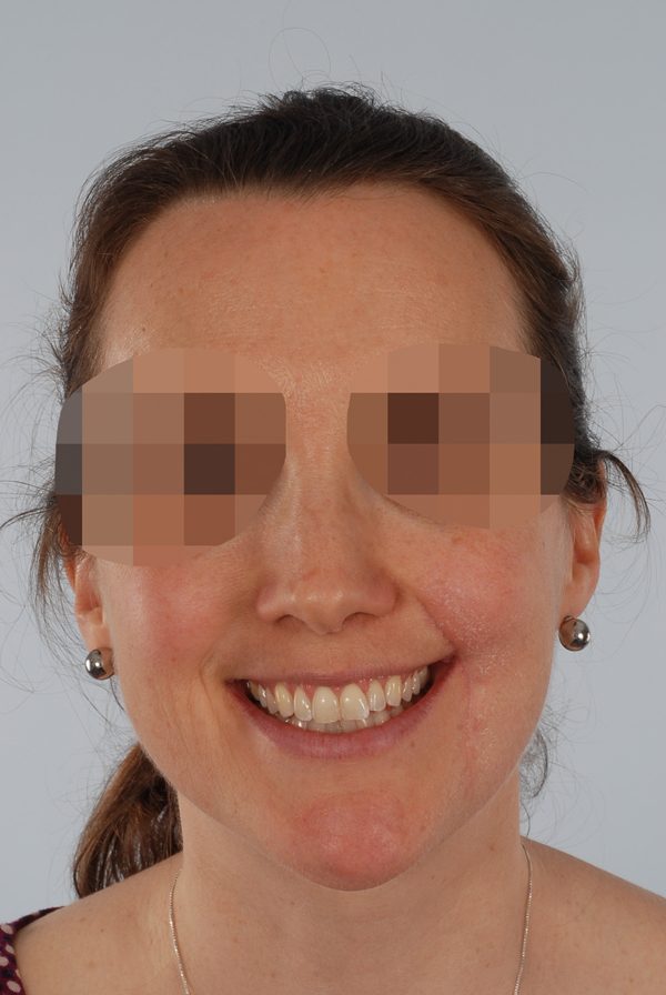 Skin Cancer Case 2098 After Photo Skin Cancer