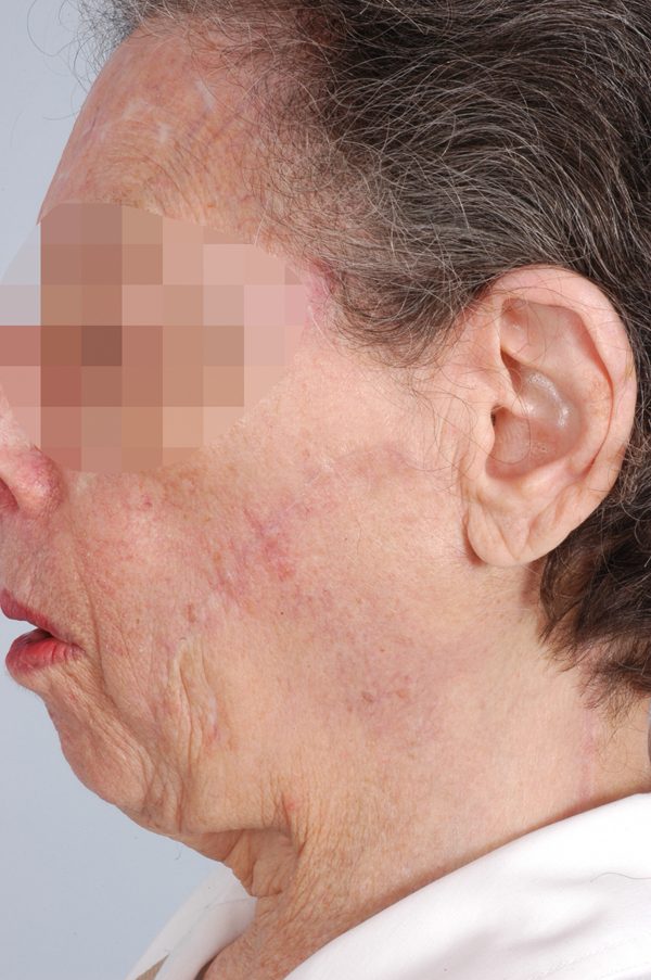 Washington DC Skin Cancer Before and After Photos McLean