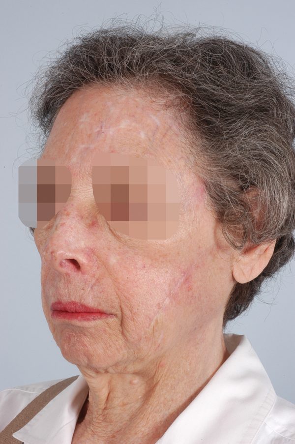 Washington Dc Skin Cancer Before And After Photos Mclean Va Plastic