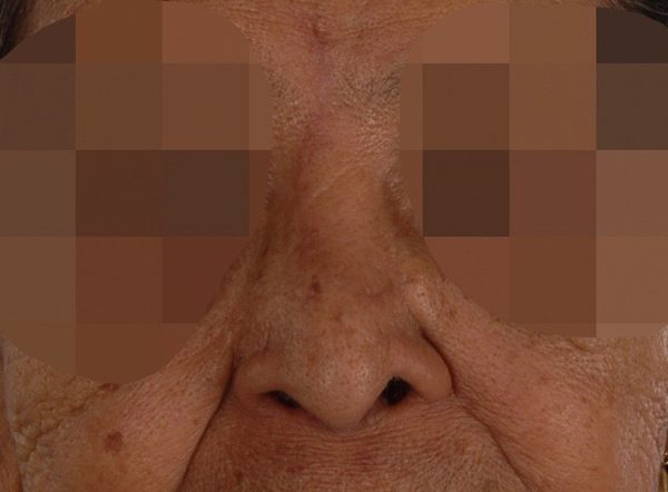 Skin Cancer Case 2135 After Photo Skin Cancer