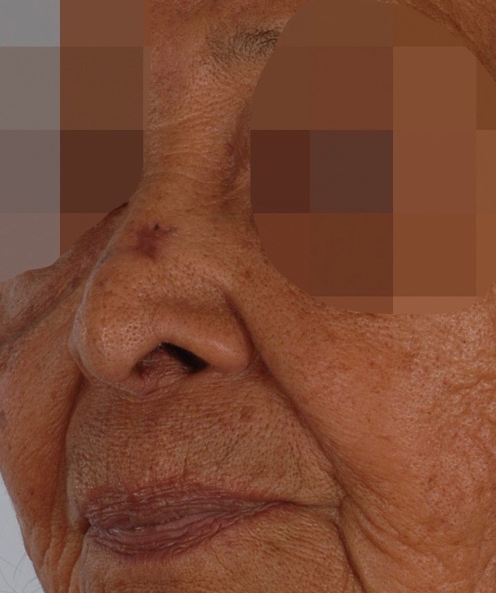 Skin Cancer Case 2135 Before Photo Skin Cancer