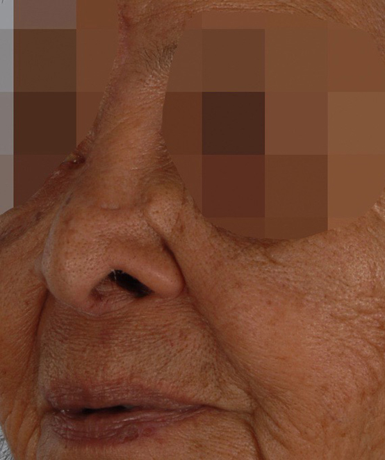 Skin Cancer Case 2135 After Photo Skin Cancer
