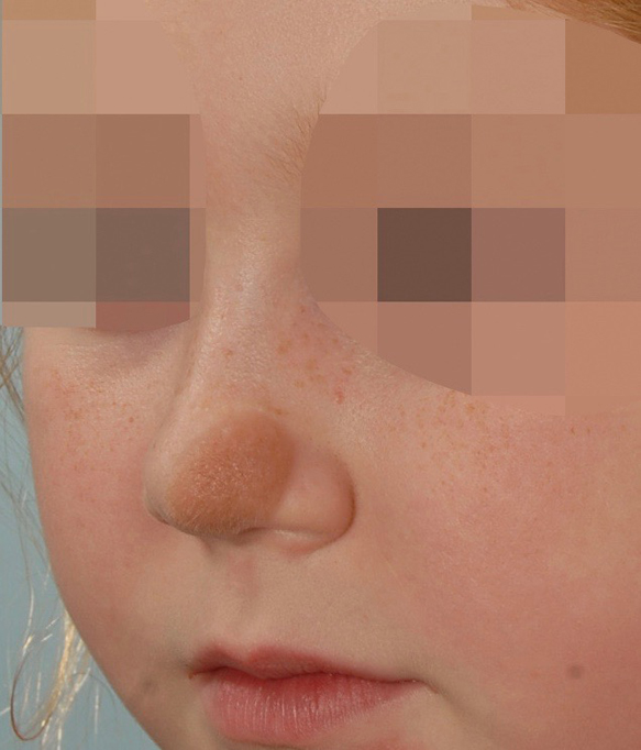 Skin Cancer Case 2141 Before Photo Skin Cancer