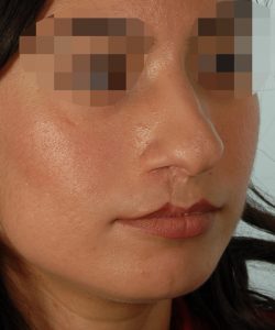 Rhinoplasty Result Washington DC