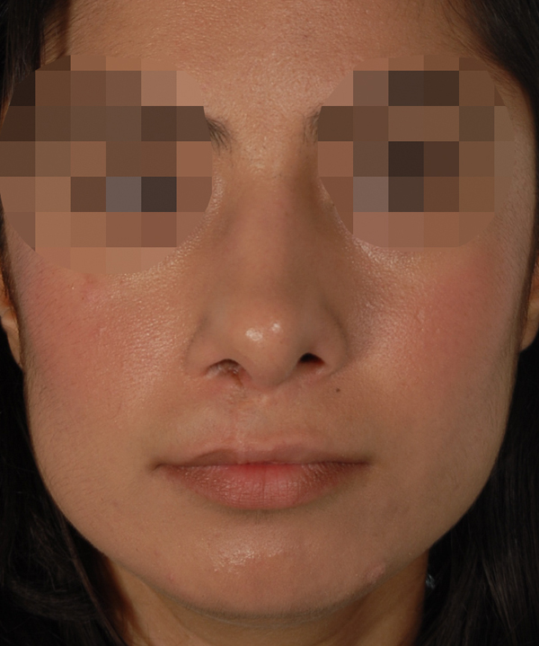 Rhinoplasty after