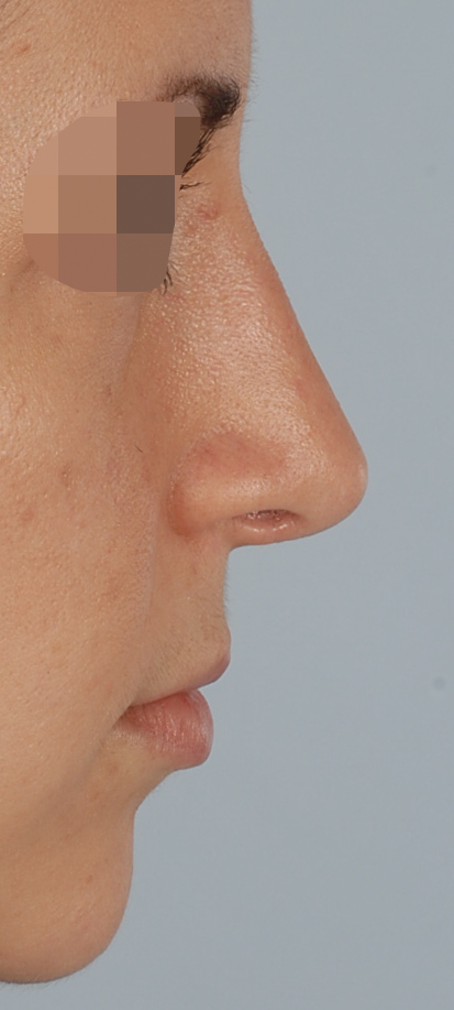 Primary Noses Case 2217 After Photo Primary Noses