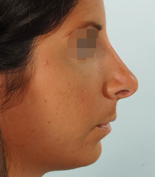 Primary Noses Case 2387 After Photo Primary Noses