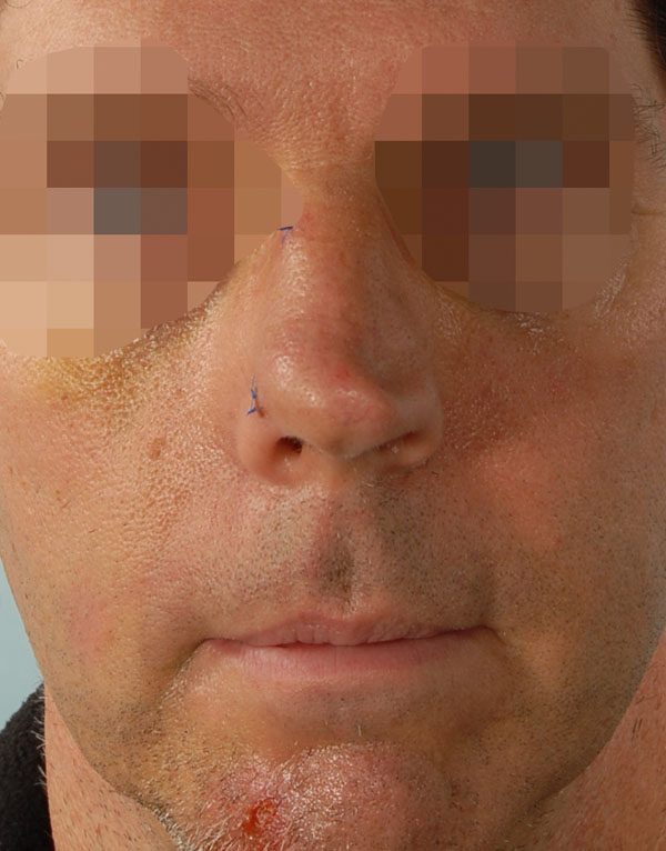 Tip Case 2598 Before Photo Tip