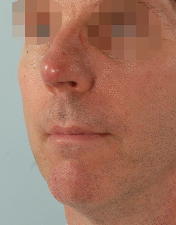 Tip Case 2598 After Photo Tip