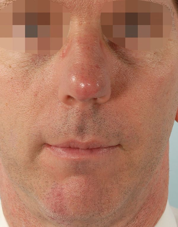 Tip Case 2598 After Photo Tip