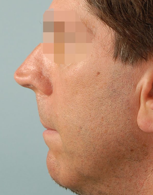 Tip Case 2598 Before Photo Tip