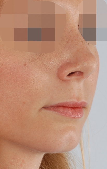 Tip Case 2606 After Photo Tip