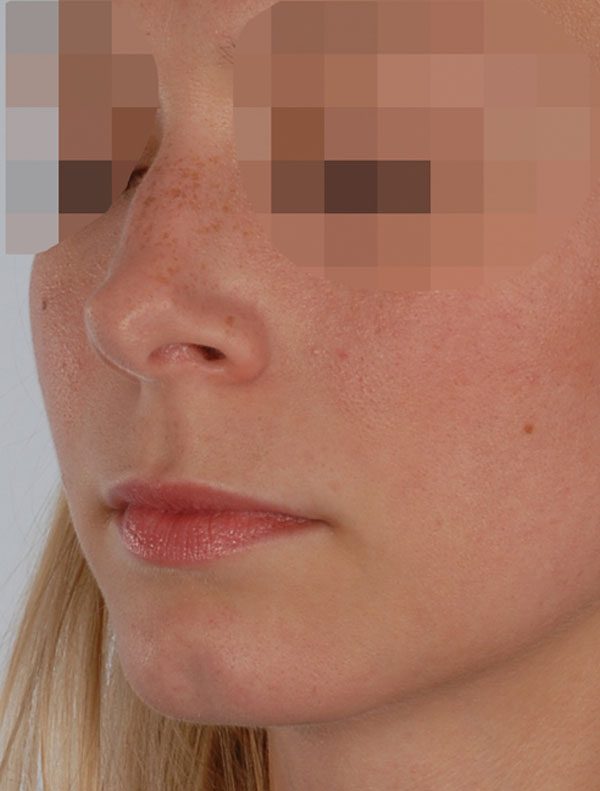 Tip Case 2606 Before Photo Tip